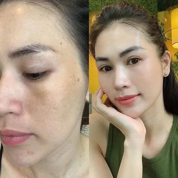 cảm nhận khách hàng KIYOMI trước và sau khi chăm sóc da giúp da trông sáng và đều màu hơn